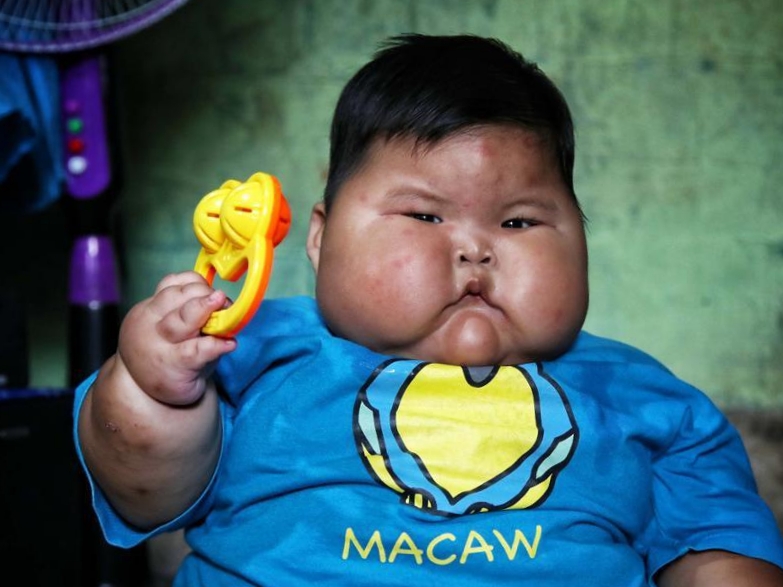 Hal hal yang menyebabkan bayi menderita obesitas yang&nbsp;parah
